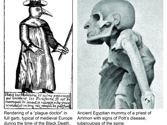A montage of two images: a plague doctor and an Egyptian mummy showing evidence of Pott's Disease